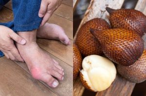 Asam Urat Tumbang Selamanya Cuma Modal Salak, Dokter Sampai Angkat Jempol Lihat Efeknya